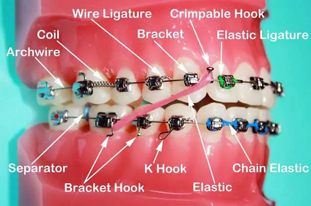 cleaning braces