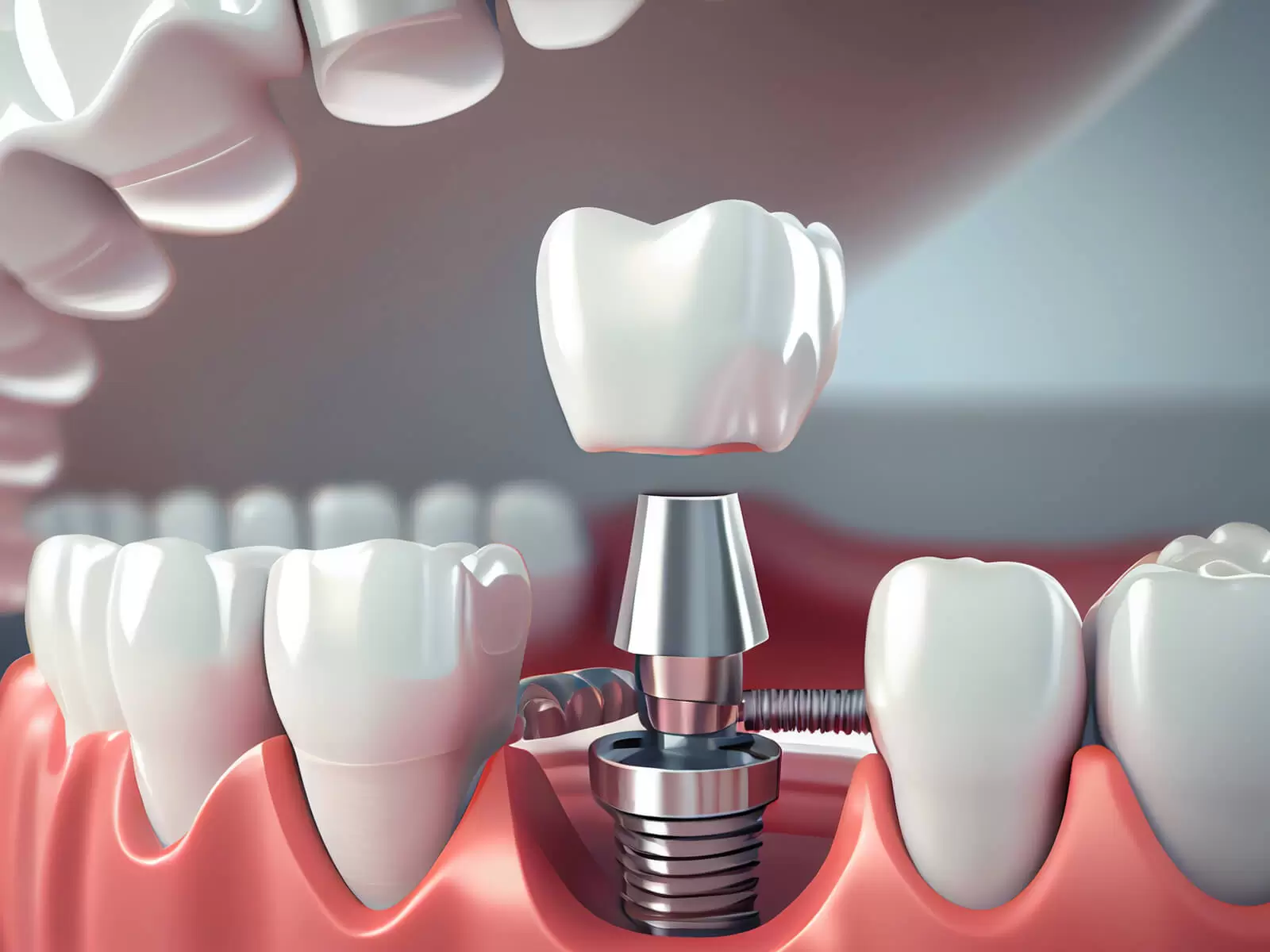 root canal treatment